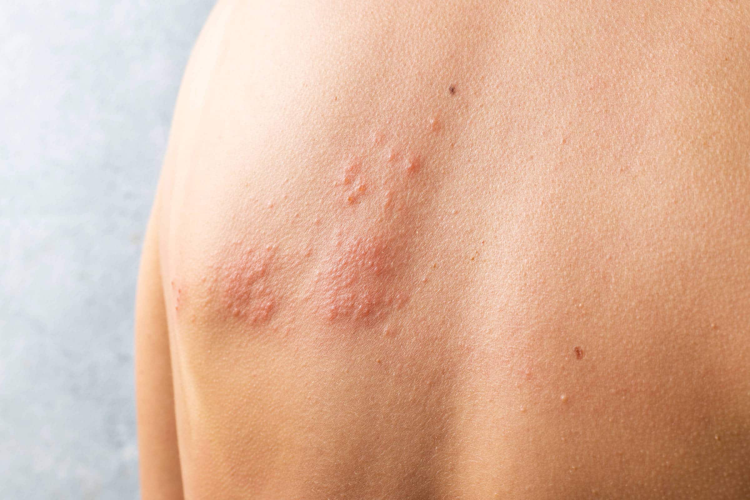 ALERTA! SUS Revoluciona Tratamento da Dermatite Atópica e Salva Vidas!