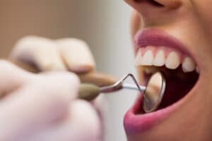Cáries em Alerta: Desvendando os Mitos que Podem Custar Seus Dentes!