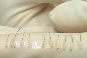 Revolução Estética: Transplante de Sobrancelhas Promete Transformar Seu Olhar!