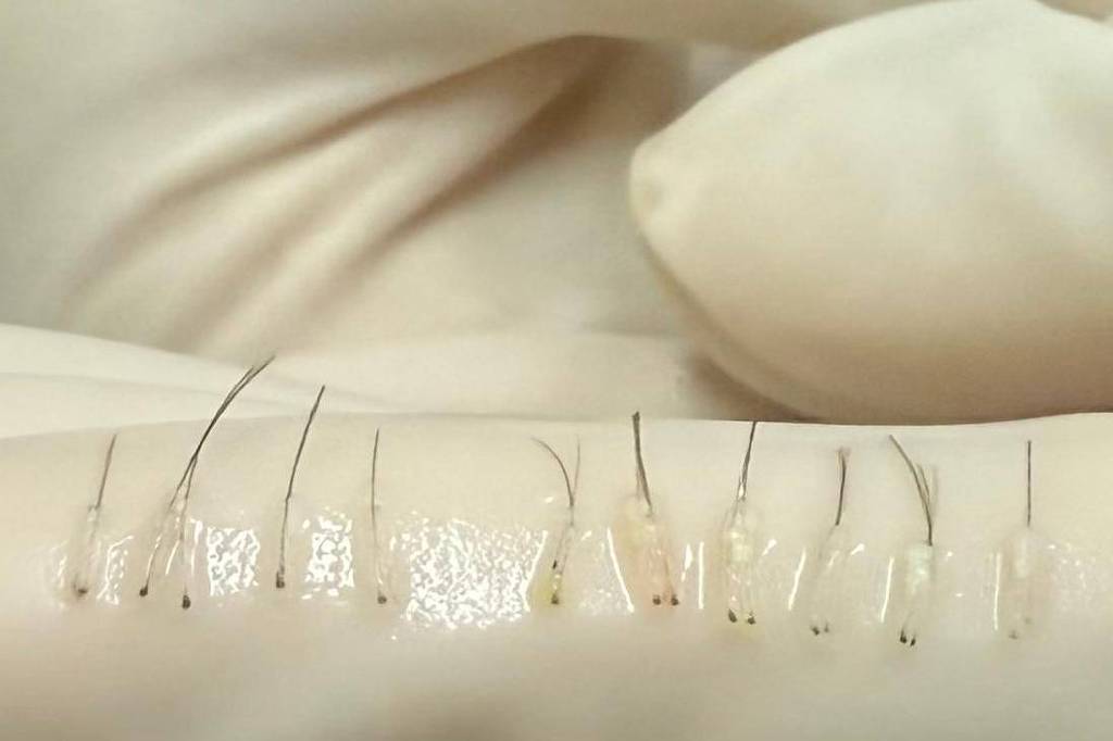 Revolução Estética: Transplante de Sobrancelhas Promete Transformar Seu Olhar!
