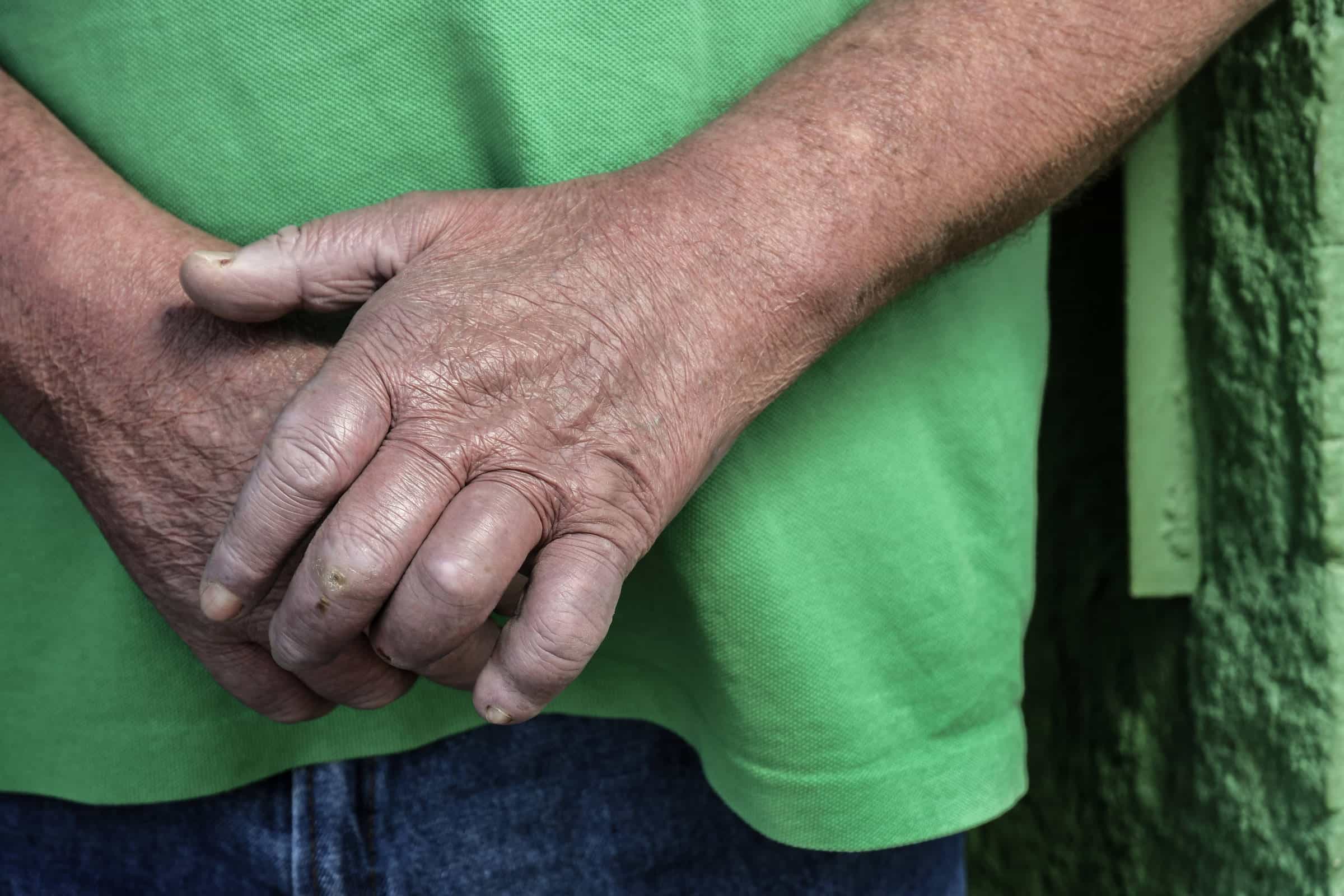 Revolução na Saúde: Novo Tratamento Promete CURA para Hanseníase!