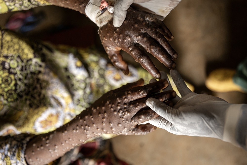 ALERTA: África Enfrenta O SURTO ASSUSTADOR de 50 Mil Casos de Mpox!