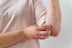 Caroço Perigoso? Descubra Quando a Urgência Exige um Cirurgião!