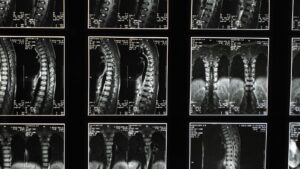 Revolução Médica: Israel Realiza Transplante de Medula Espinhal que Pode Mudar Tudo!