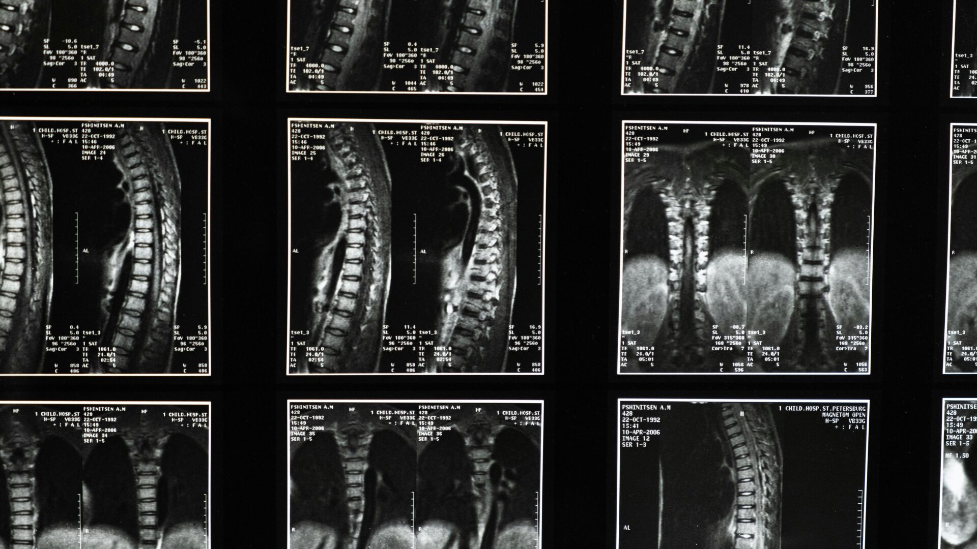 Revolução Médica: Israel Realiza Transplante de Medula Espinhal que Pode Mudar Tudo!