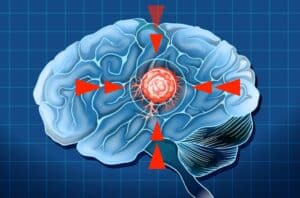 Alerta Máximo: O Gigante Implacável do Glioblastoma Desafia a Medicina!