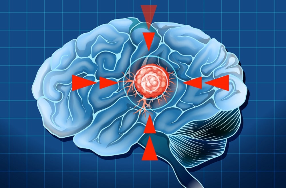 Alerta Máximo: O Gigante Implacável do Glioblastoma Desafia a Medicina!